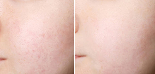 New Mentholatum ACNESS Derma Relief Recovery Cream