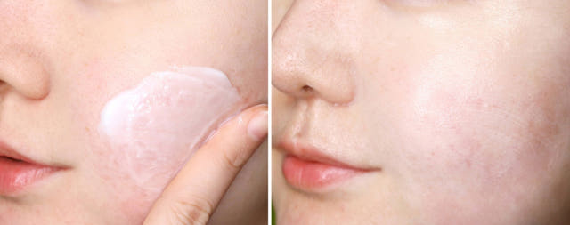 New Mentholatum ACNESS Derma Relief Recovery Cream