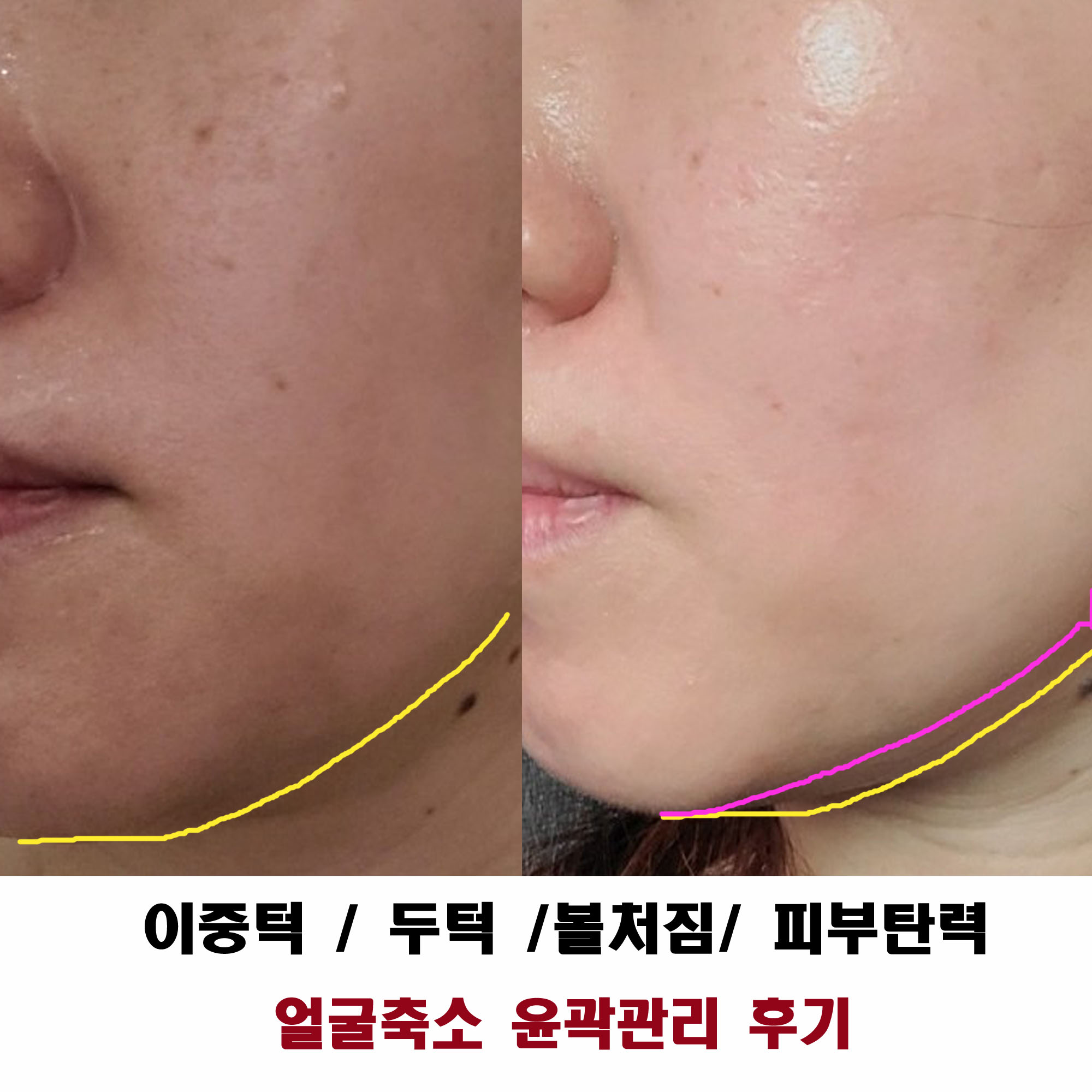 김포피부관리실 물방울리프팅 DPL 얼굴축소 스킨케어 김민희스파유르 : 김포피부관리 김민희스파유르