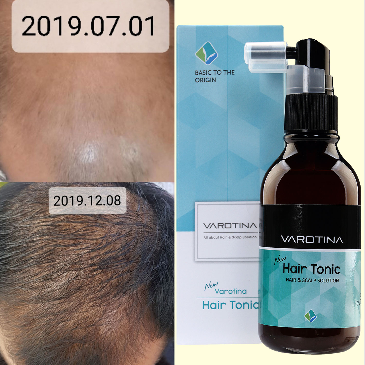 바로티나 뉴헤어토닉 탈모 영양제 엠자 정수리 두피 탈모에 좋은 영양제 100ml : 바로티나