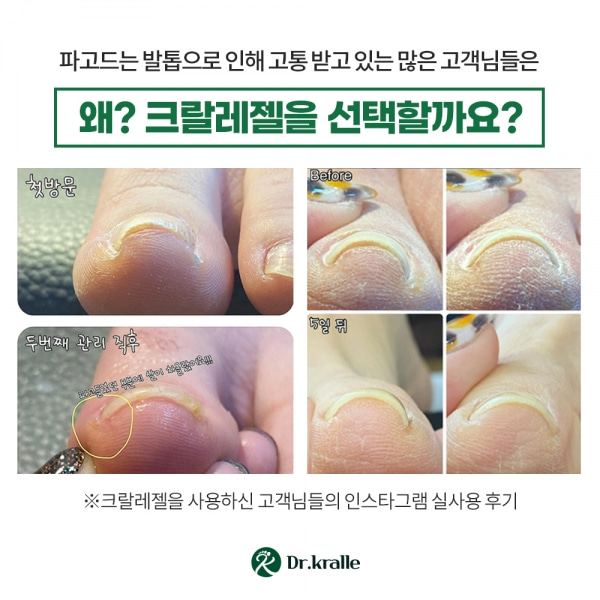 닥터크랄레 크랄레젤 미니 3종세트 6ml 파고드는발톱 손톱 페디케어 레진젤 C커브손발톱 : 로미오코스-ROMEOCOS