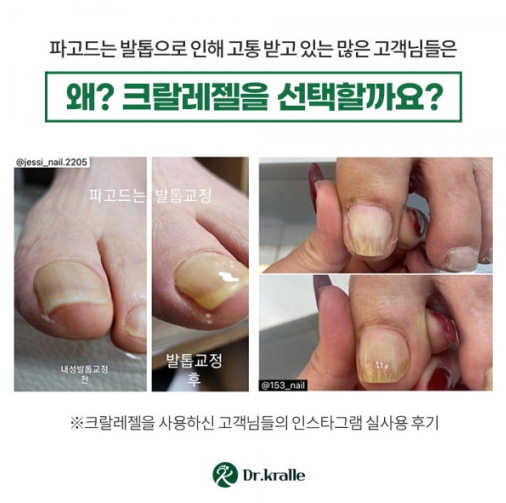 닥터크랄레 크랄레젤 미니3종 세트 6ml 파고드는발톱 손톱 페디케어 레진젤 C커브손발톱 : 윤슬코스메틱