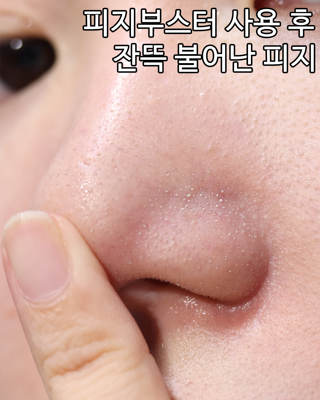 매드스킨케어 피지제거 인어프랙션 블랙헤드 모공팩 연화제MAD : 윈윈픽
