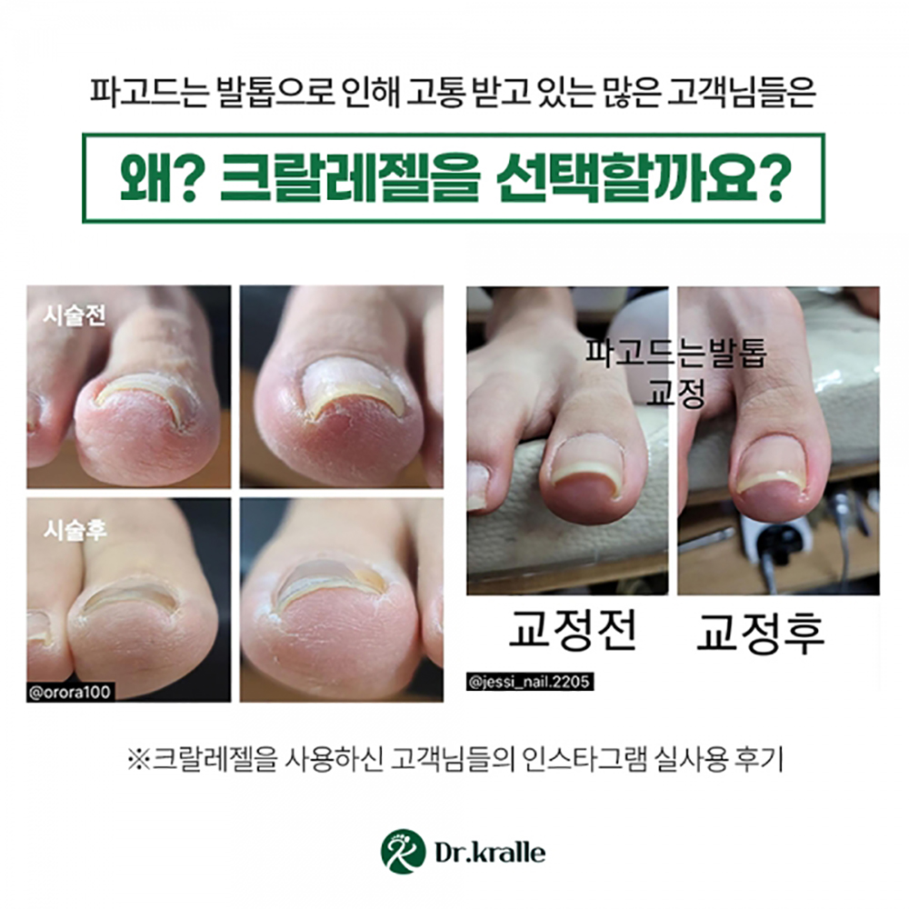 내향성 내성 발톱교정기 파고드는 뇌성 내성 발톱 젤 치료 교정 연화제 : 두두 마켓