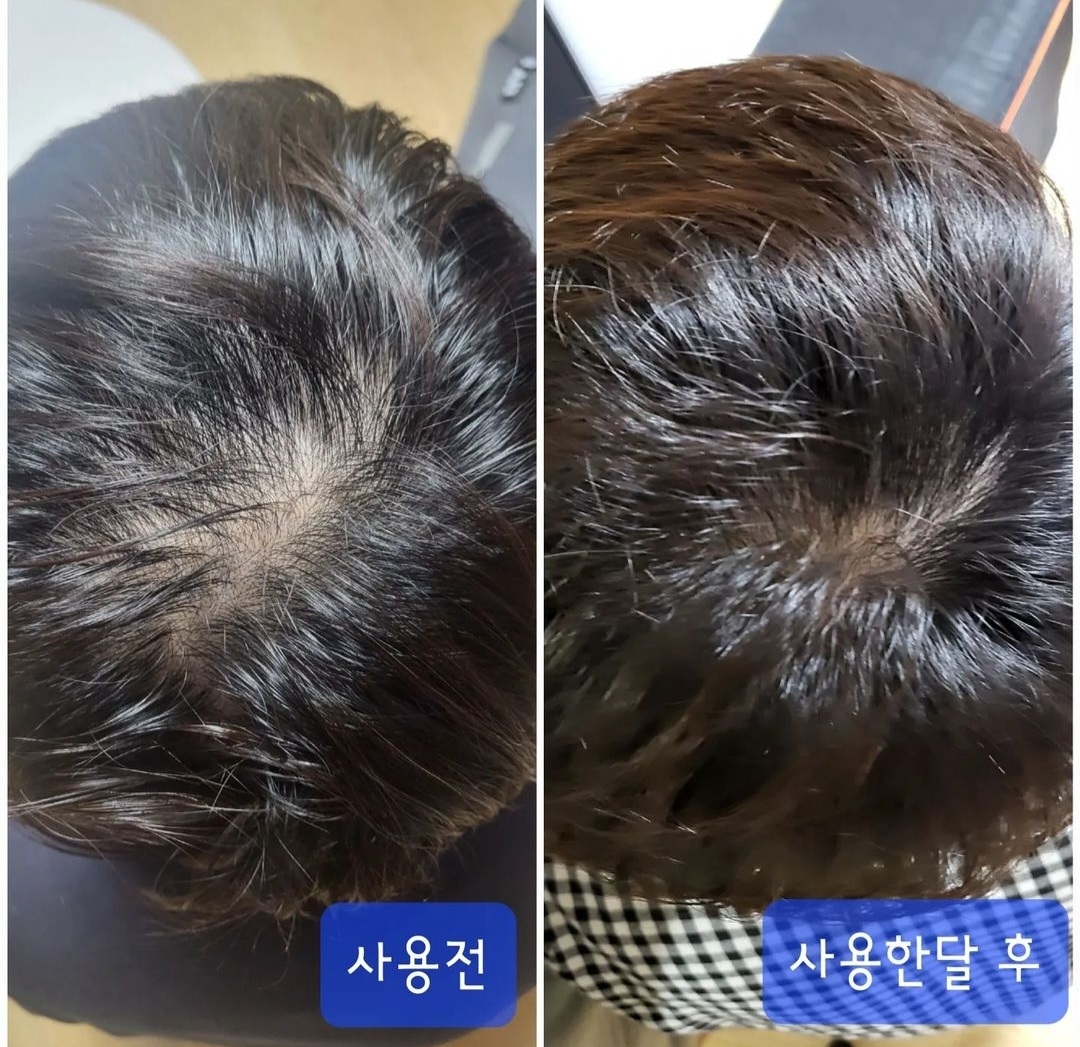(탈모전문) 엑소힐 엑소좀 탈모기능성 헤어세트 병원입점제품 : 지야뷰티몰