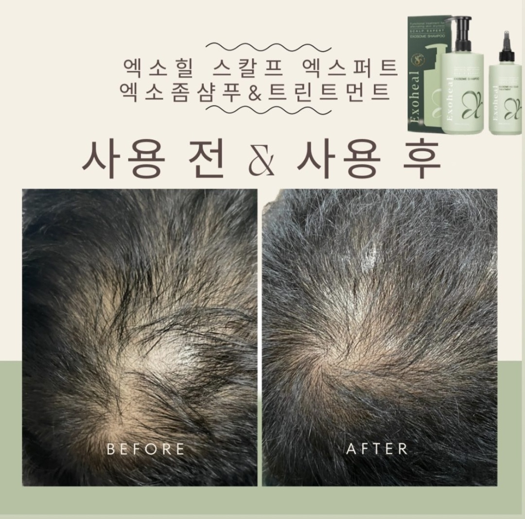 (탈모전문) 엑소힐 엑소좀 탈모기능성 헤어세트 병원입점제품 : 지야뷰티몰