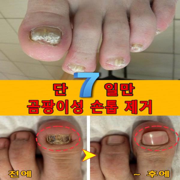 손톱 문제를 해결하고, 다양한 곰팡이 복구 에센스가 함유되어 있습니다. : 라피나 슈퍼