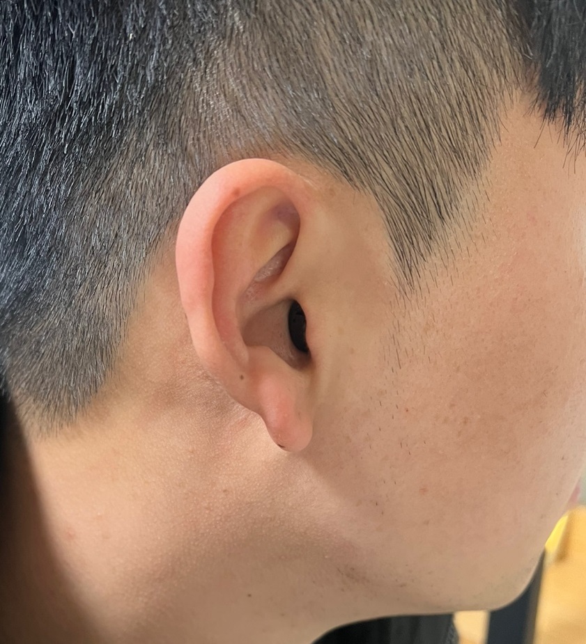 젊은난청인 소음성난청 제레나 초소형보청기 귓속형 스위스보청기 좌측 : 주식회사 맑음히어링테크