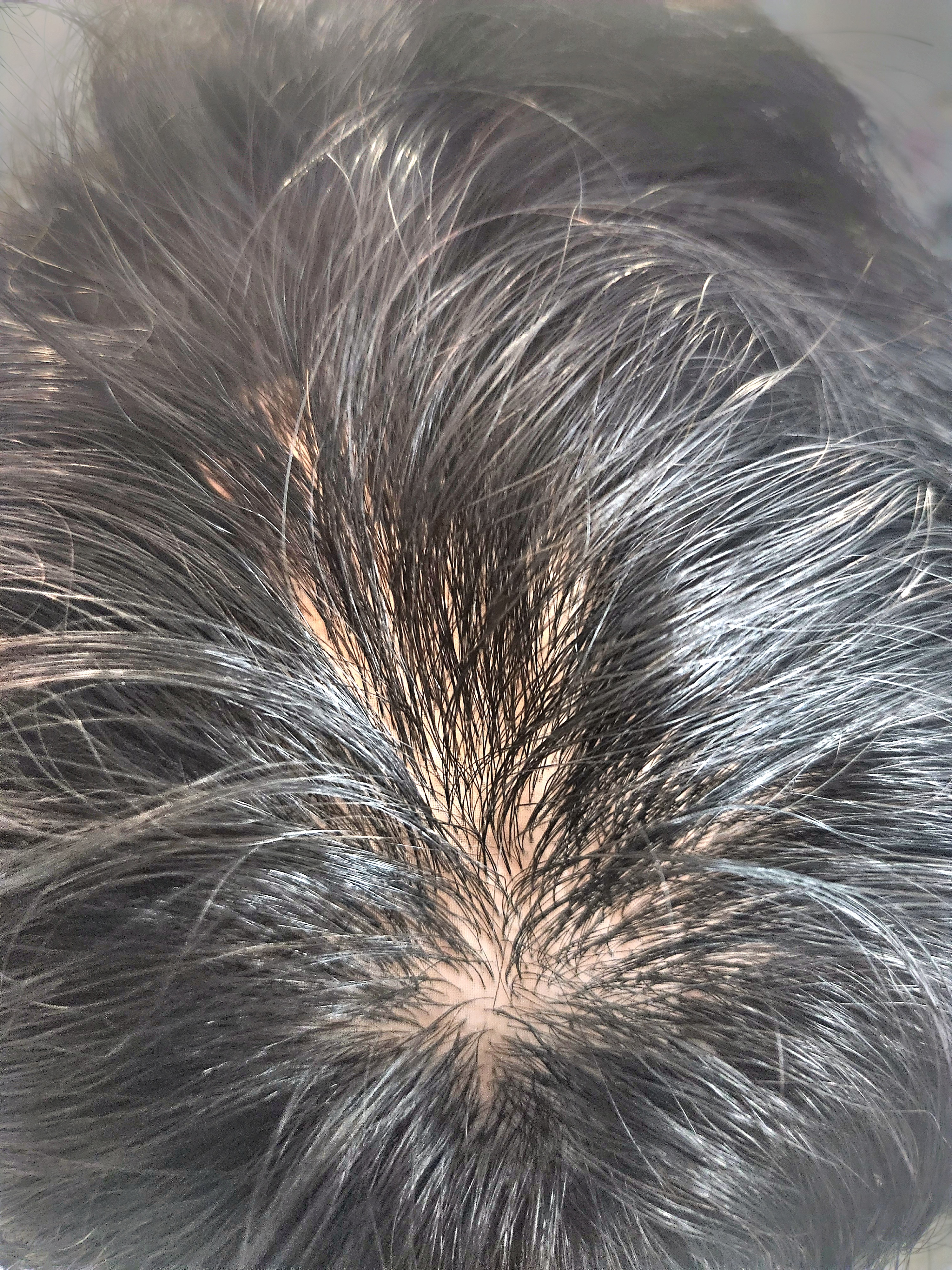 남자 정수리가발 : 플러스모발